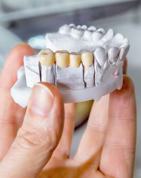 A dental bridge on a mouth mold 