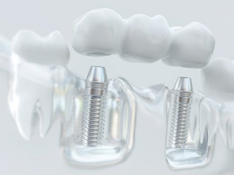 a 3D example of a dental bridge and implants