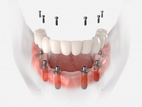 a 3D illustration of a denture and dental implants