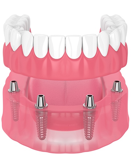 Illustration of implant dentures in Huntsville, OH for lower arch