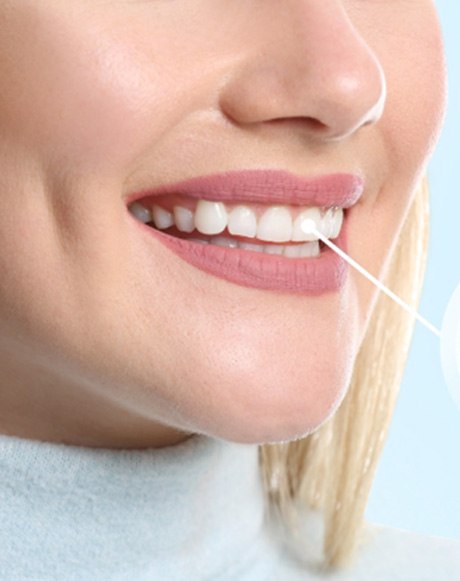 Nose to chin view of blond woman smiling with a diagram pointing to her dental implant