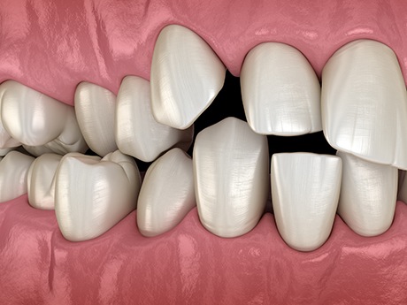 Illustration of spaced out teeth