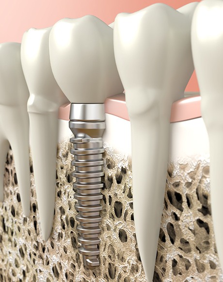 Digital illustration of dental implants