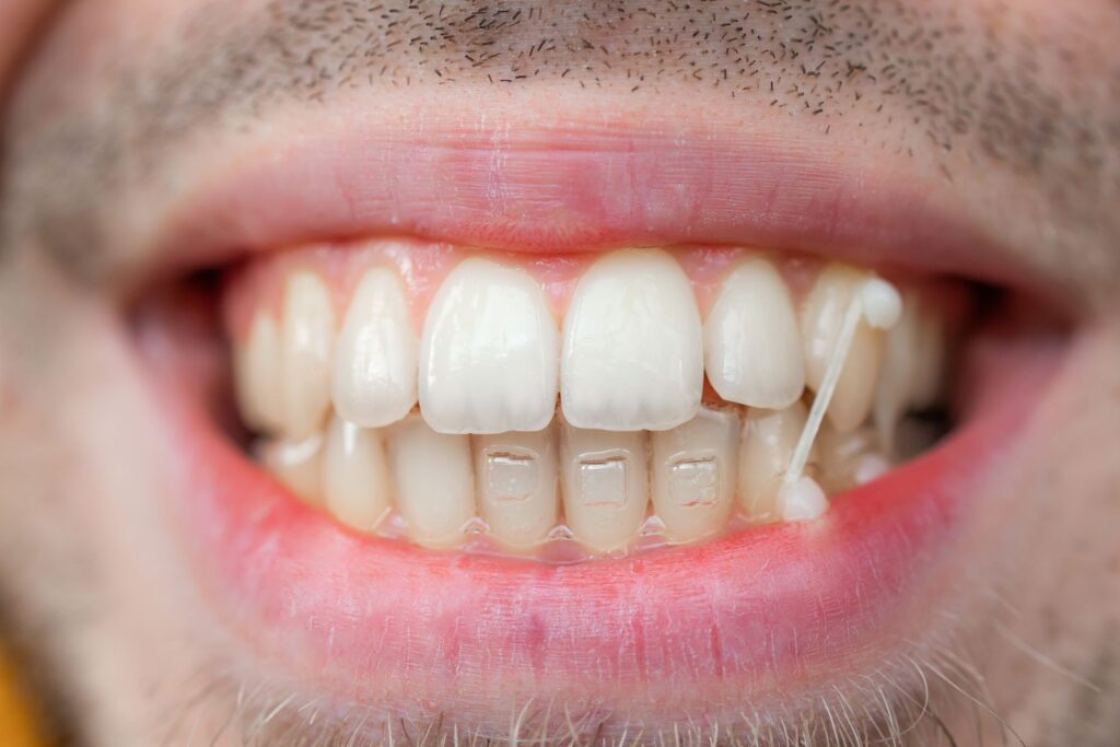 Closeup of man's teeth with Invisalign attachments on lower arch